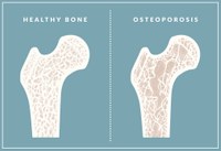 May is Osteoporosis Awareness Month