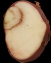 Tobacco Rattle Virus in Potato