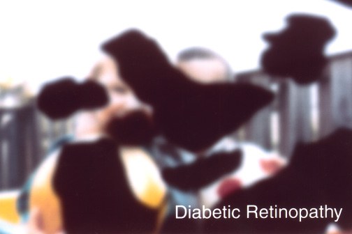 Diabetic Retinopahy
